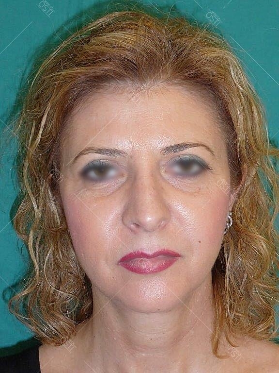 nose job italy